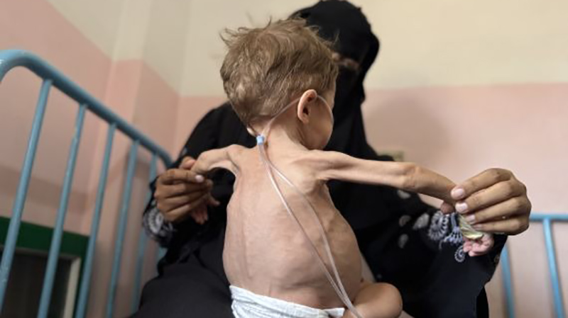 A skeletal child suffering from hunger in Gaza